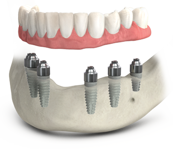 Implant retained denture.png