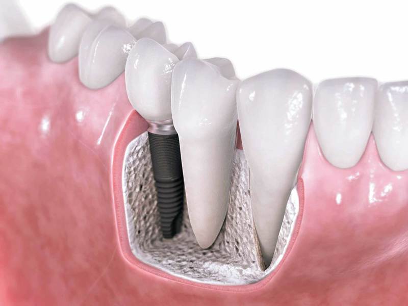 Dental Implants.jpg