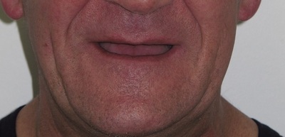 dentures1.JPG