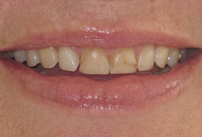 pre veneer_5053[1].jpg