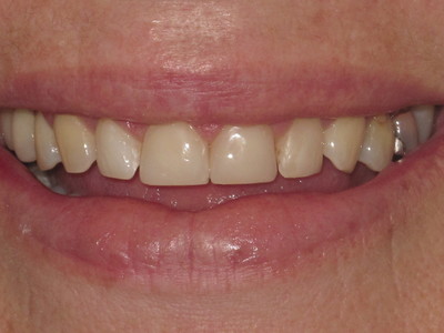 post veneers_5058[1].jpg