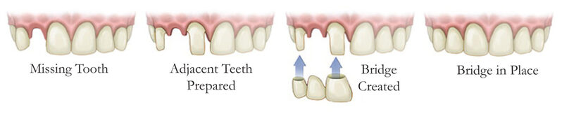 dental bridges in Adelaide.jpg